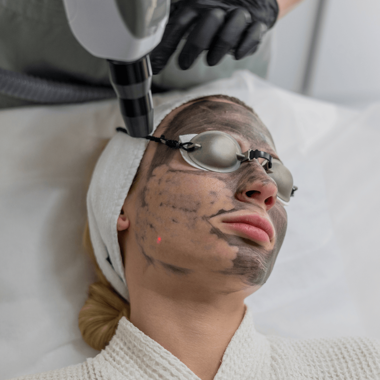 Client receiving a carbon laser facial peel treatment at Frangipani Skin & Body clinic for deep pore cleansing and skin refining.