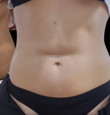After - Body contouring 1