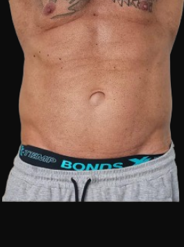 Client abdomen after body contouring treatment showing reduced belly fat, tighter skin, and a smoother waistline.