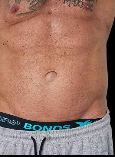 After - Body contouring 6