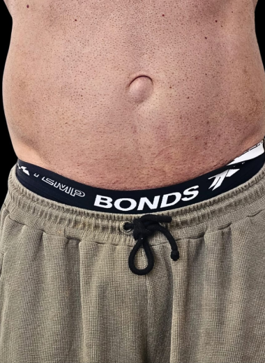 Before - Body contouring 6