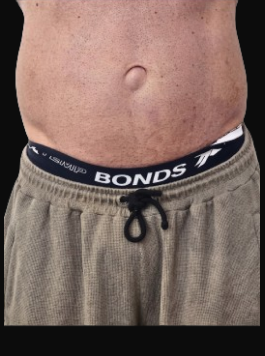 Client abdomen prior to body contouring treatment showing localized belly fat and skin laxity.