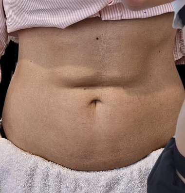Before - Body contouring 1