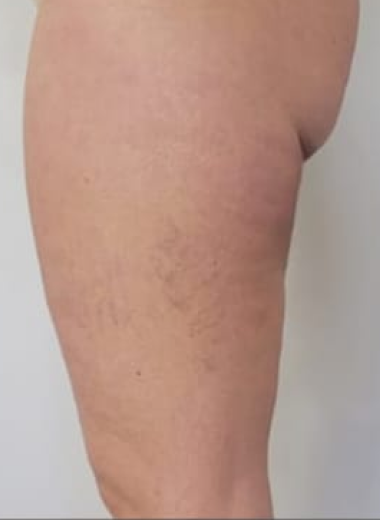 After - Cellulite before after 1