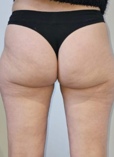 After - Cellulite before after 5