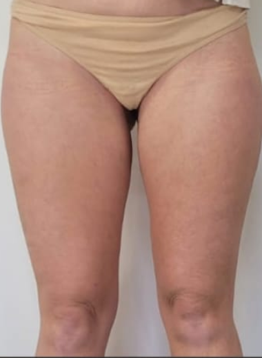 After - Cellulite before after 1