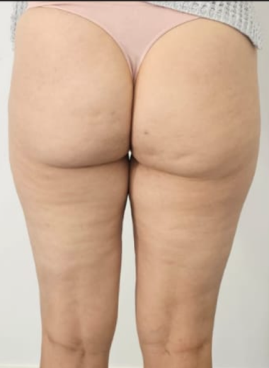 After - Cellulite before after 6
