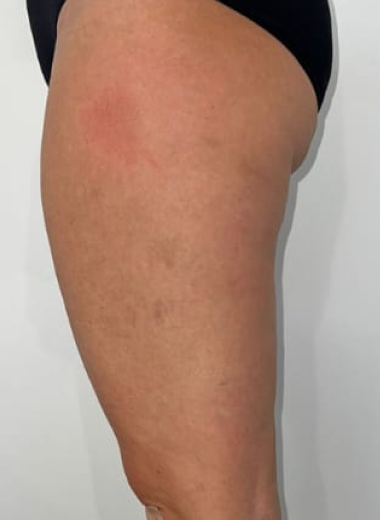 After - Cellulite before after 4