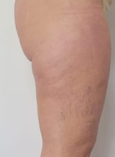 After - Cellulite before after 1
