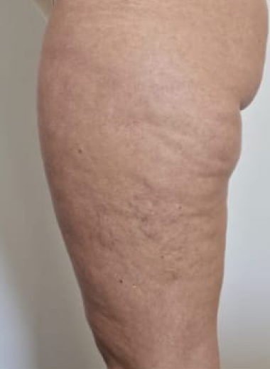Before - Cellulite before after 1