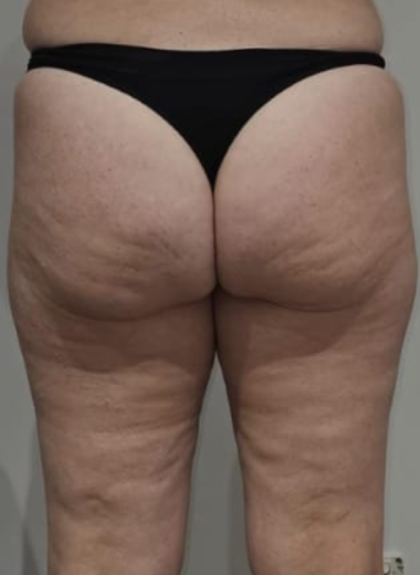 Before - Cellulite before after 5
