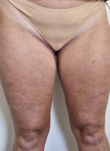 Before - Cellulite before after 1