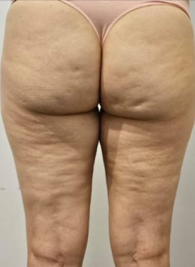 Before - Cellulite before after 6
