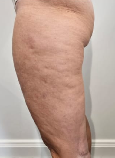 Before - Cellulite before after 4