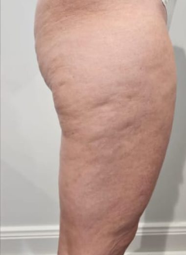 Before - Cellulite before after 5