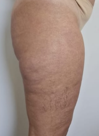 Before - Cellulite before after 1