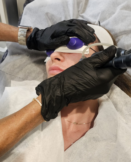 C02 Laser Resurfacing