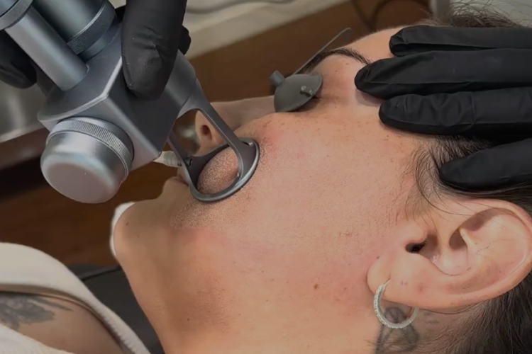 Close-up of a patient undergoing a fractional CO2 laser resurfacing procedure for skin renewal in a cosmetic dermatology clinic.