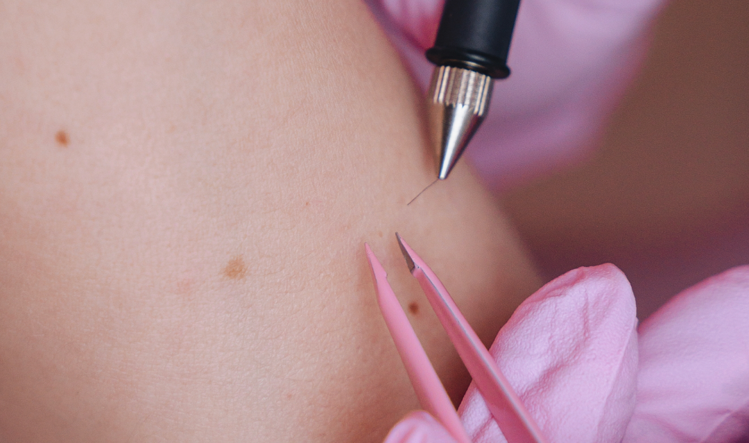 Electrolysis (Permanent Hair Removal)