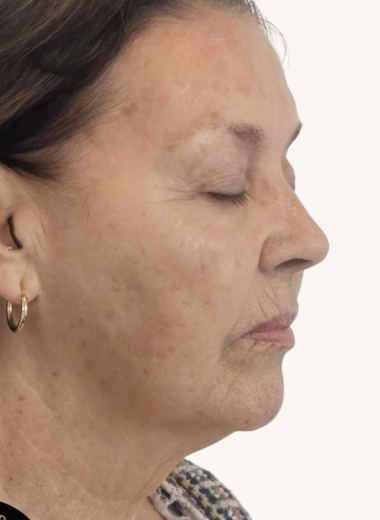 After - face before after
