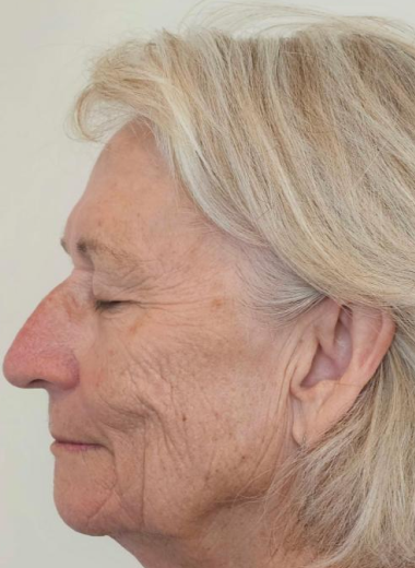 After - Fine lines/eye area before and after