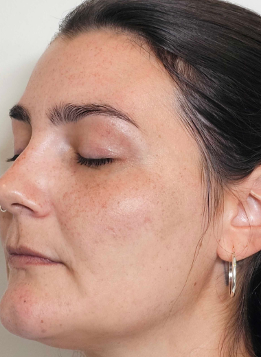 After - skin before after 13