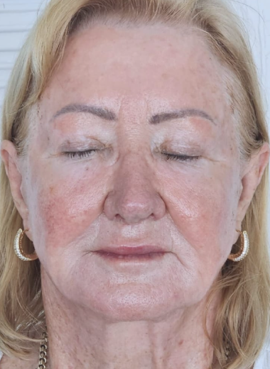 After - skin before after 14
