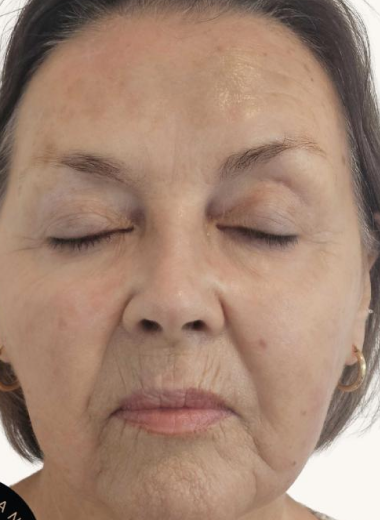 After - skin before after 14