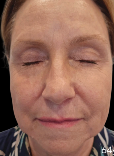After - skin before after 18