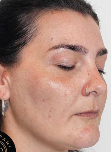 After - skin before after 13