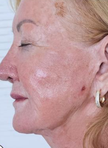 After - skin before after 7-3