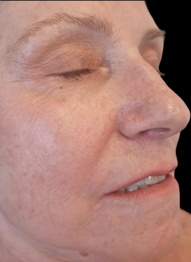 After - skin before after 8
