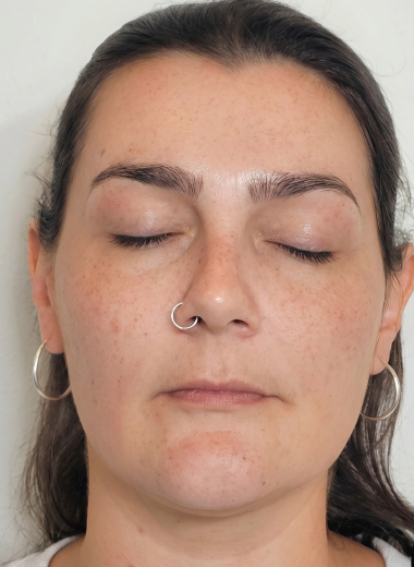 After - skin before after 1-1