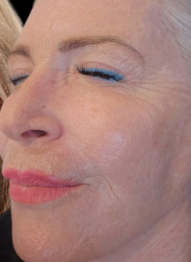 After - skin before after 5