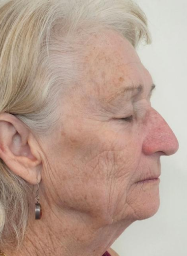 After - skin before after 15-1
