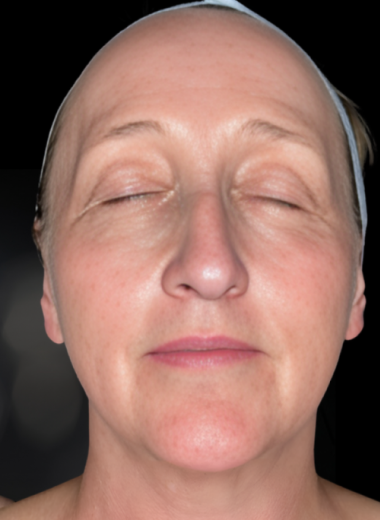 After - skin before after 7