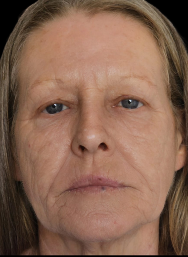 After - skin before after 9