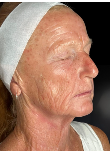 After - skin before after 11
