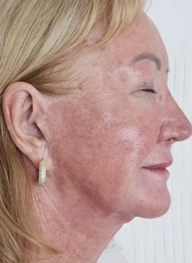 After - Skin before after-2