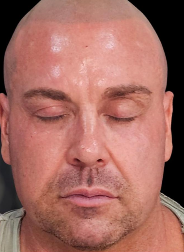 After - skin before after 4