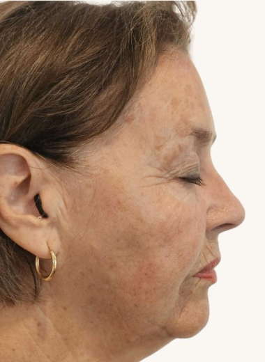 Before - face before after