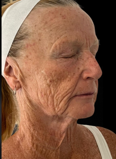 Before - skin before after 11