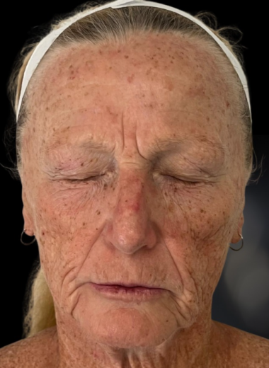 Before - skin before after 12