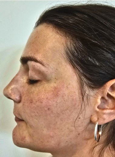 Before - skin before after 13
