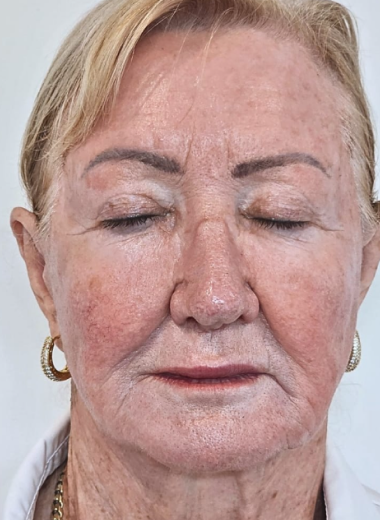 Before - skin before after 14