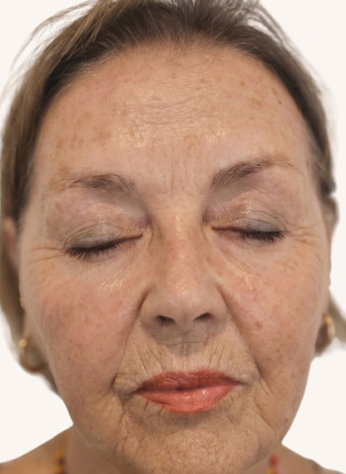 Before - skin before after 14