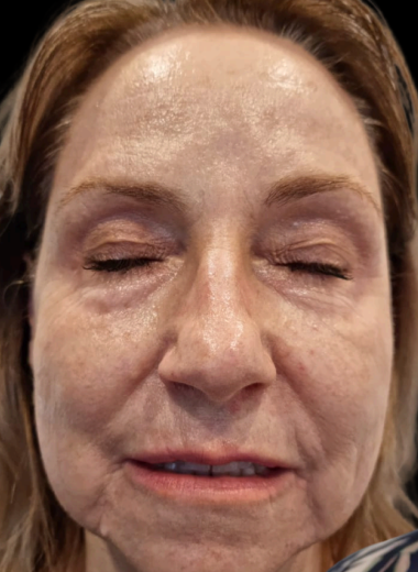 Before - skin before after 18