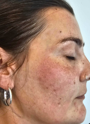 Before - skin before after 13