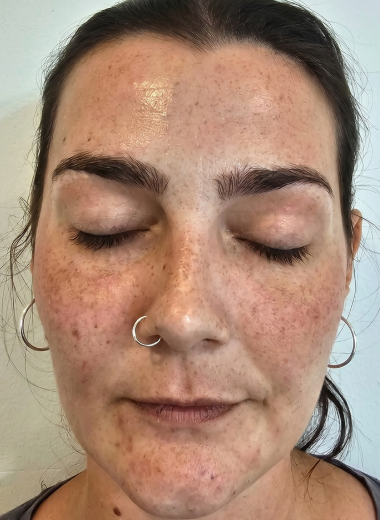 Before - skin before after 1-1