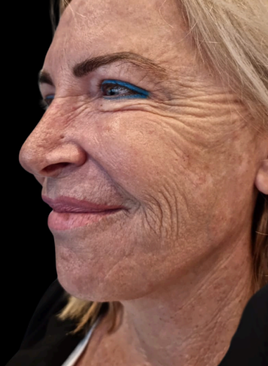 Before - skin before after 5